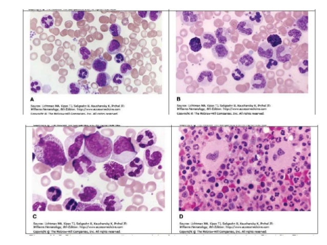 leucemia mielogena cronica